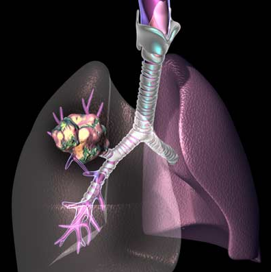 非小细胞肺癌(Non-Small Cell Lung Cancer) （上）