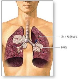 晚期非小细胞肺癌靶向治疗进展
