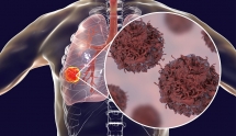 【TR文献】硫氧还蛋白还原酶在肺癌临床检测中应用