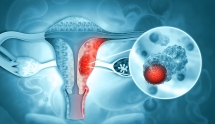 【TR文献】血浆硫氧还蛋白还原酶水平检测对宫颈癌早期诊断的价值研究